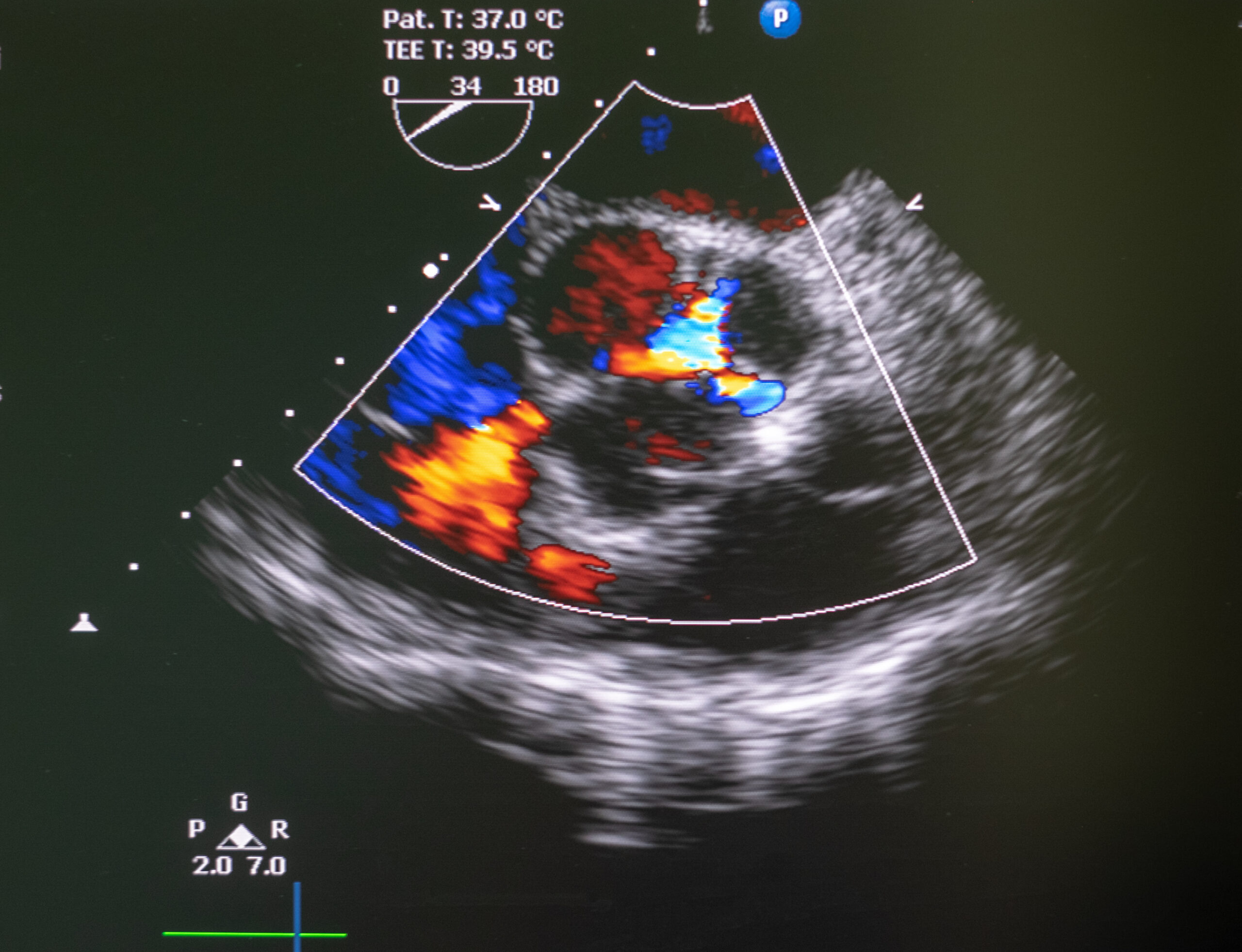 Echocardiographic strain analysis